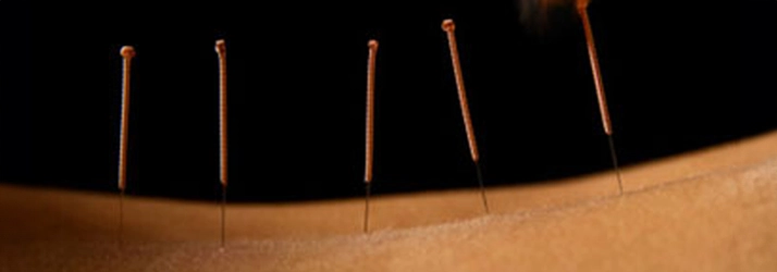 Chiropractic Alexandria VA Dry Needling On Back